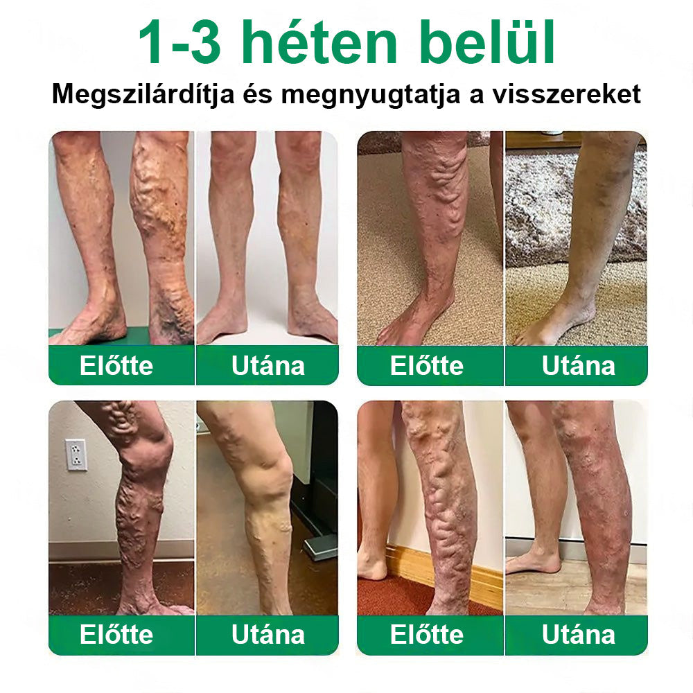 Twisma® VeinTarget – Fejlett mikro tapasz a visszerekre 🔥 96% klinikailag igazolt hatékonyság ⚡ Látható eredmények már 7–14 nap alatt 🌿 Kíméletes támogatás a könnyebb és felszabadult lábakért  🦵
