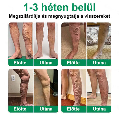 Twisma® VeinTarget – Fejlett mikro tapasz a visszerekre 🔥 96% klinikailag igazolt hatékonyság ⚡ Látható eredmények már 7–14 nap alatt 🌿 Kíméletes támogatás a könnyebb és felszabadult lábakért  🦵