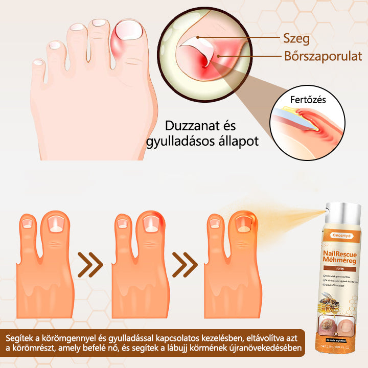 2026🎁 Korlátozott idejű akció 70% kedvezménnyel ️️⏳ Ceoerty® körömgomba spray méhméreggel 💥 2 hét alatt megoldja az összes körömproblémát